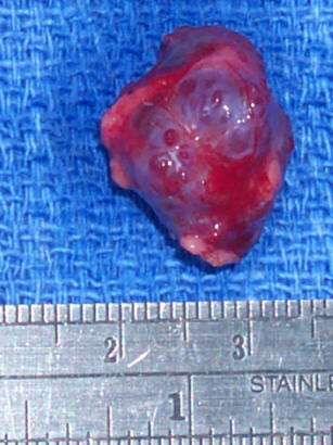 Cavernous Hemangioma medical image showing vascular structures